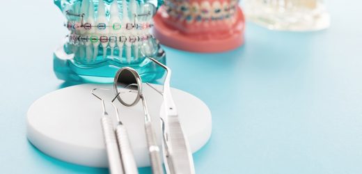 Ce modele de aparate dentare exista?
